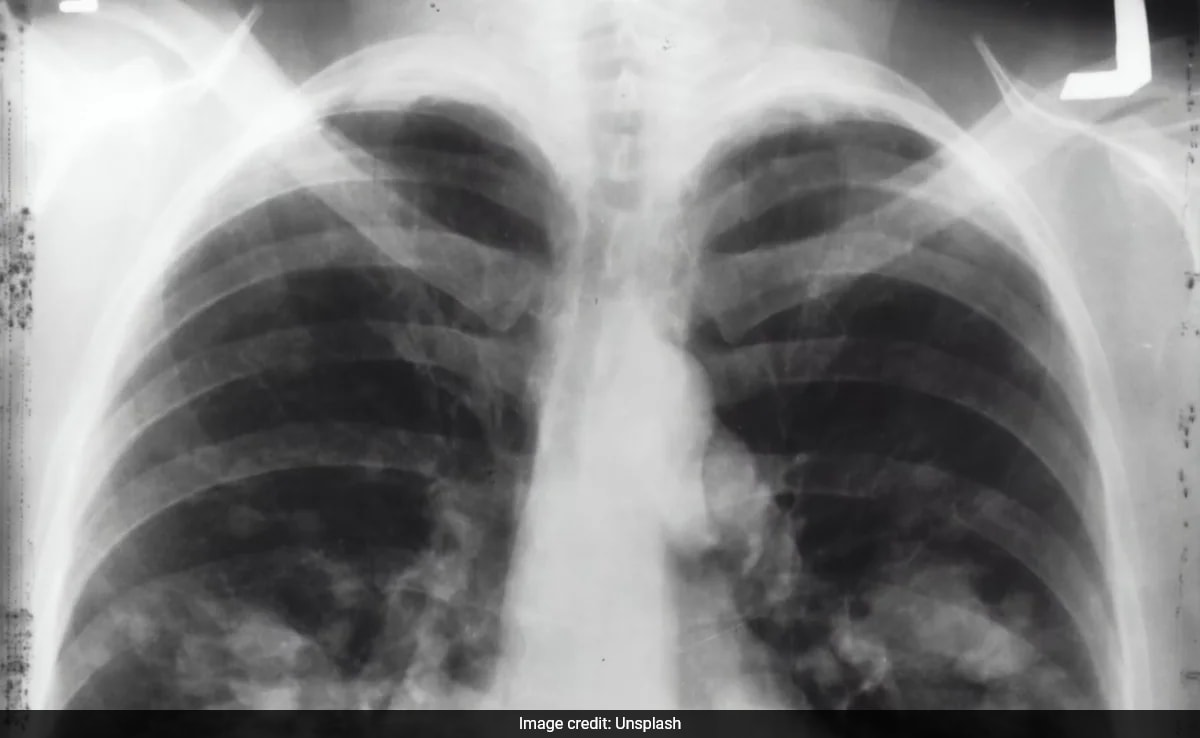 tblvcuk lungs
